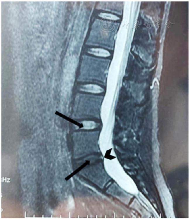 姿势解密技术治疗持续性生殖器官兴奋紊乱/生殖器官-骨盆感觉障碍综合征一例并文献复习