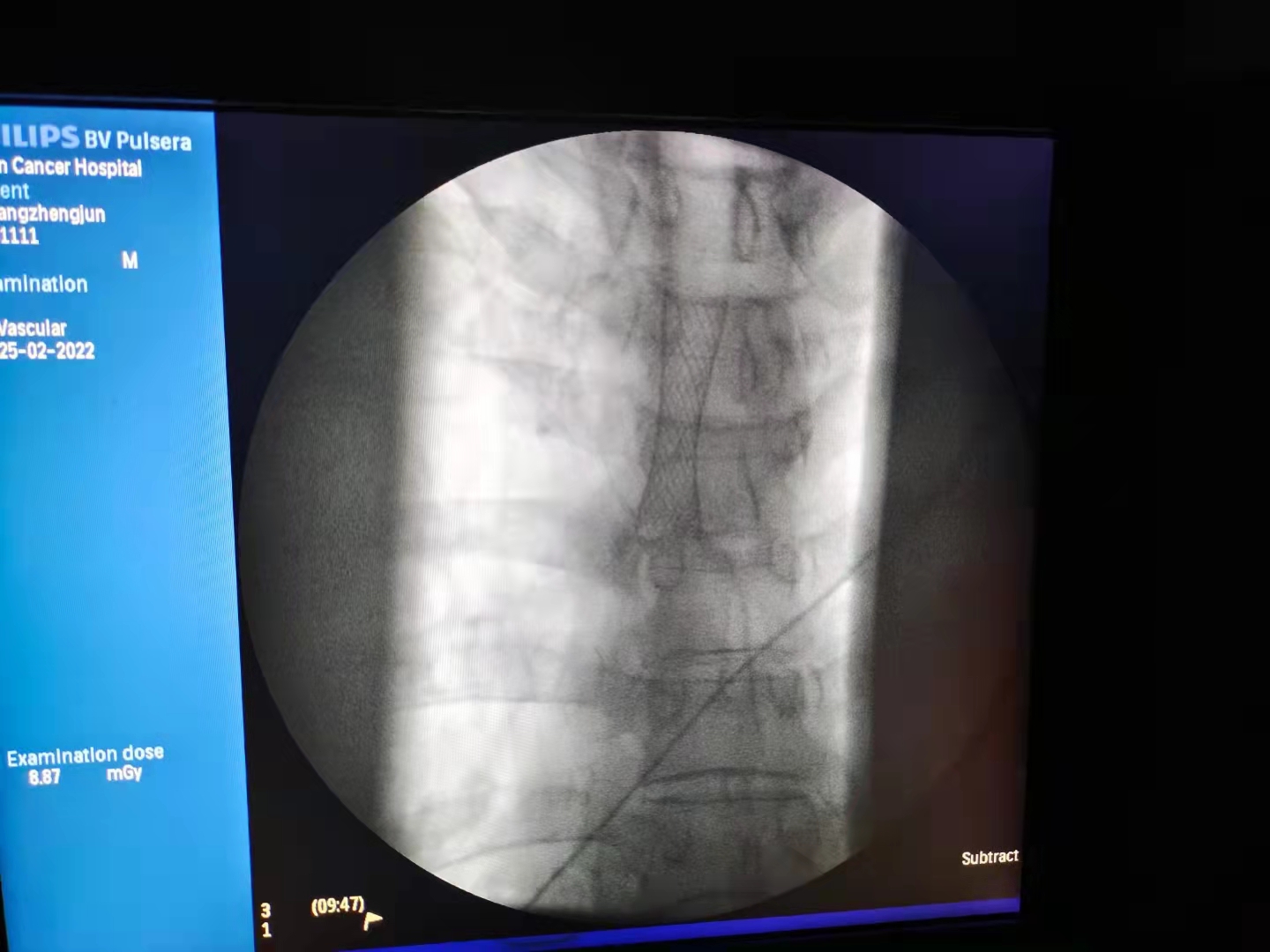 患者男性51岁食管癌进食困难3个月,食管癌手术6年后吃中饭吞咽困难