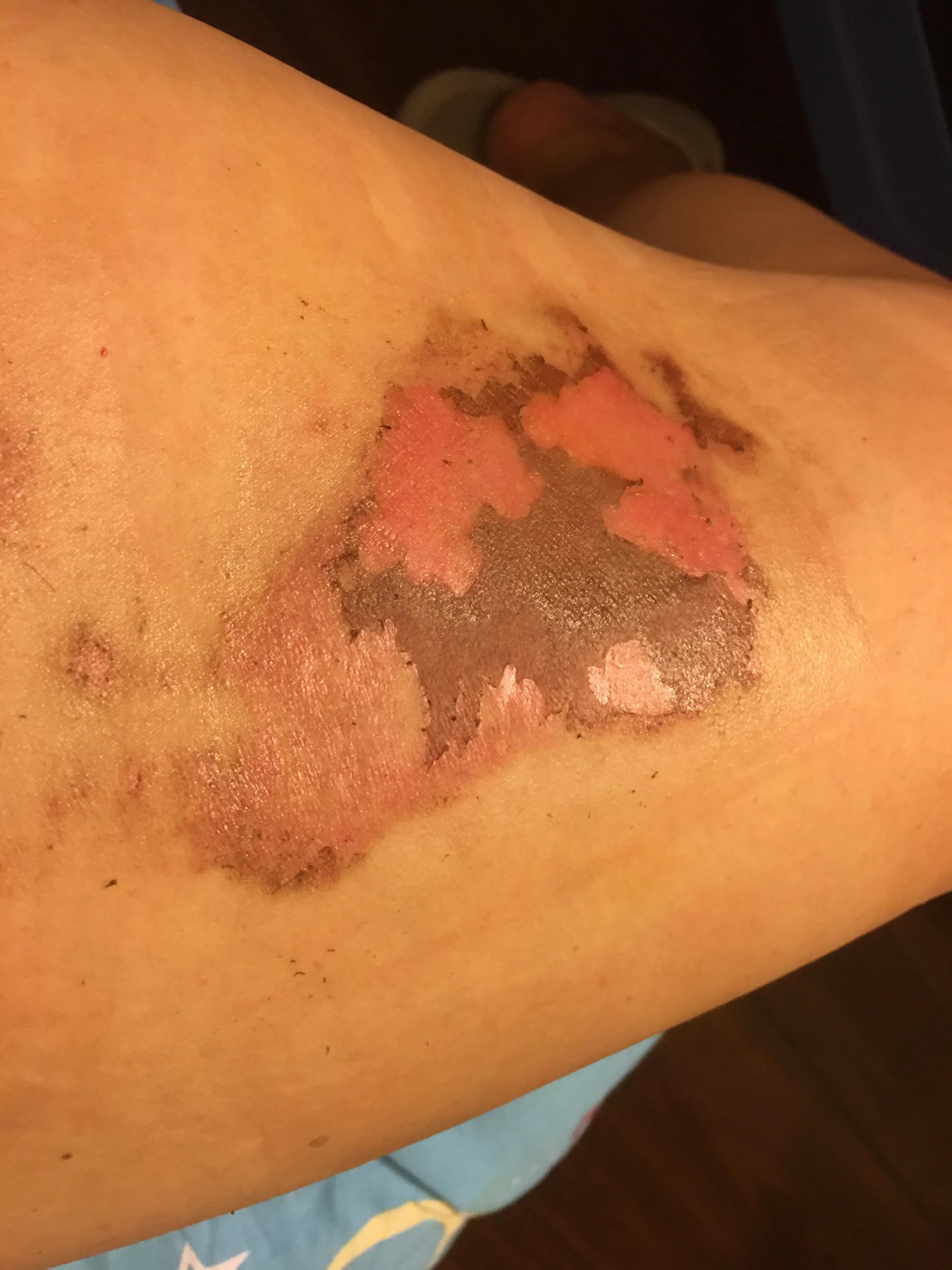 烫伤后的正确处理方法就这五个字,知识分享烫伤后的正确处理方式