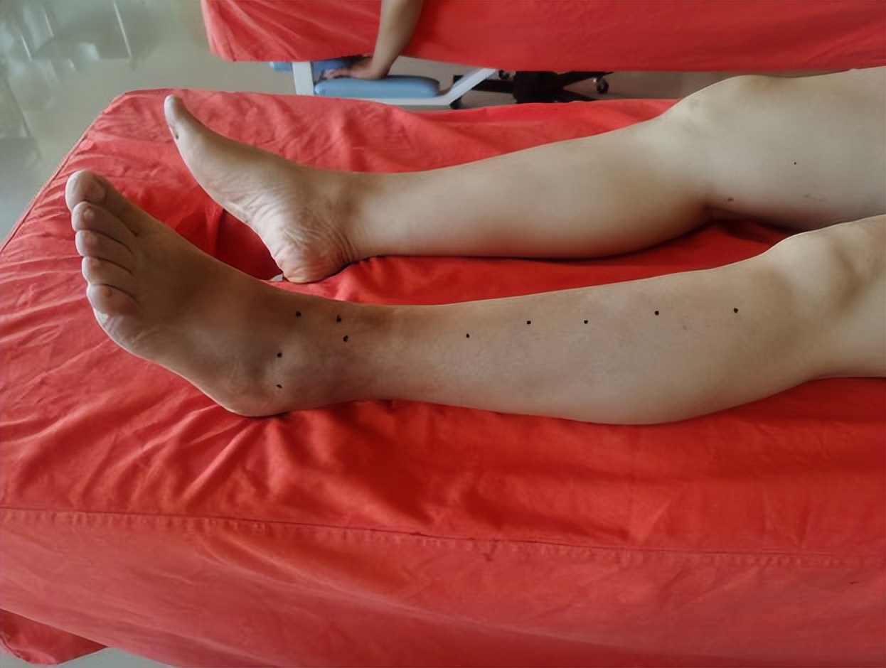 踝关节习惯性扭伤如何理疗,踝关节扭伤增生怎么治疗