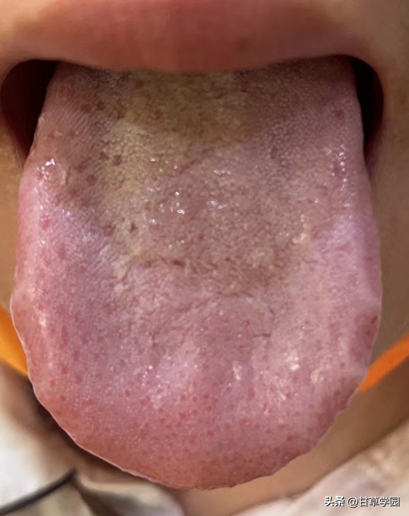 甘草学园|【思考】治疗乙肝、多囊得到明显缓解