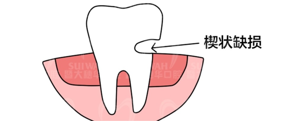 牙齿缝隙越来越大是怎么回事,45岁牙齿缝隙越来越大能矫正吗