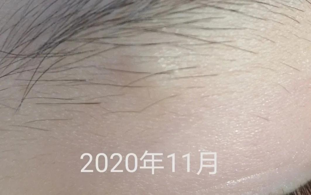 皮脂腺囊肿和粉刺瘤,火针治疗皮脂腺囊肿