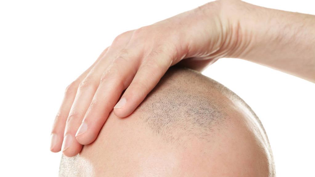 26岁脱发特别厉害秃了怎么办,26岁小伙脱发的烦恼