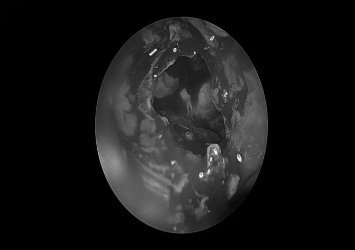 南昌二附院耳鼻喉科手术,南昌大学第二附属医院耳鼻咽喉科