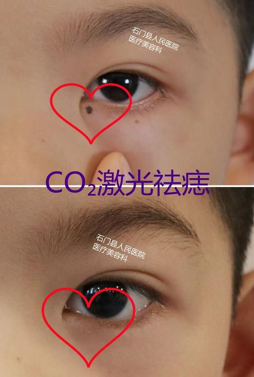 有痣人士点痣要慎重,肉痣怎么点痣最靠谱