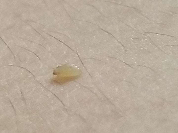 美容院清洁黑头会让毛孔变大吗,黑头拔了毛孔变大会自己愈合吗