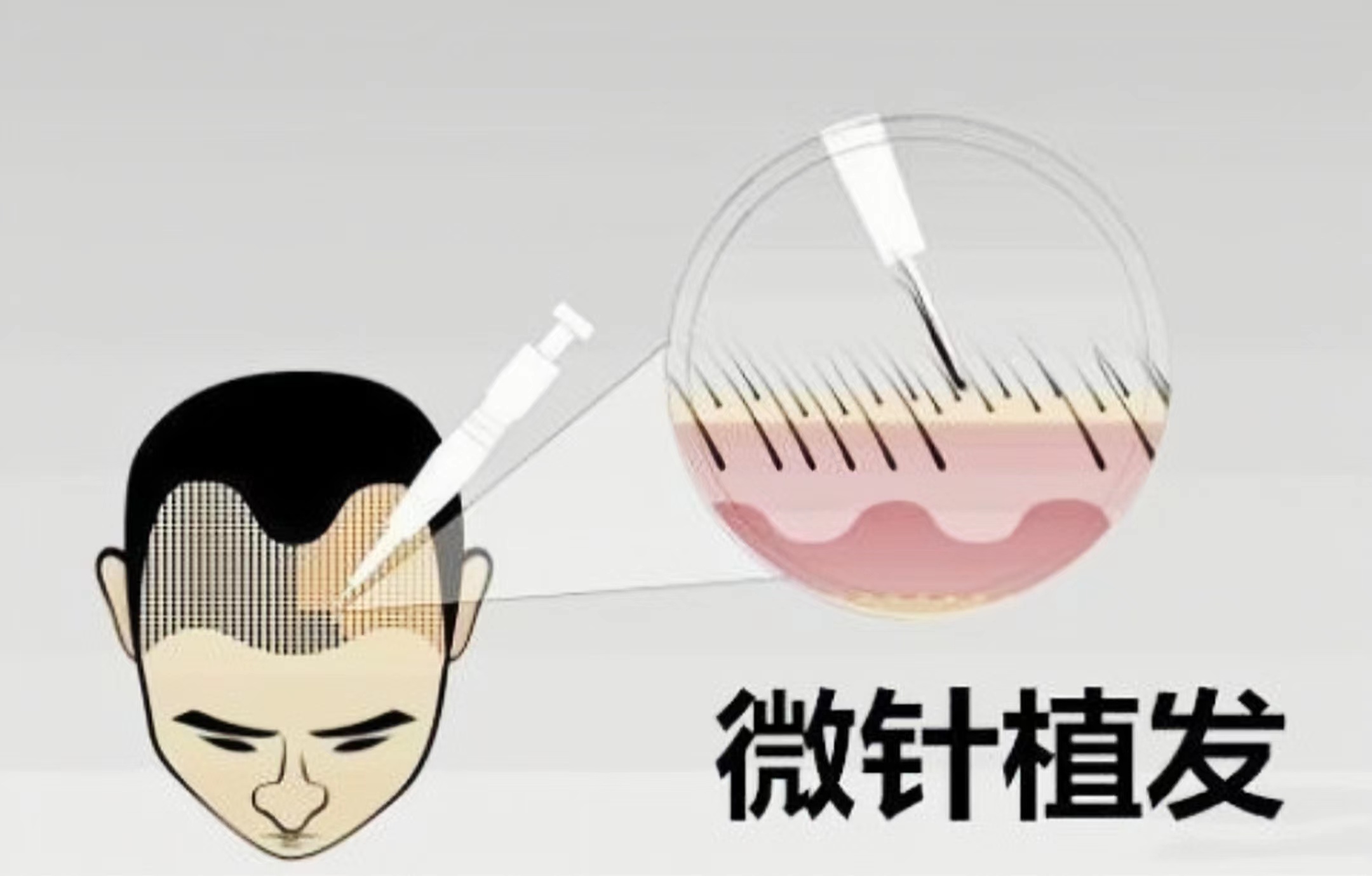 植发5g微针和mih微针有什么区别,微针植发和宝石刀植发对比图