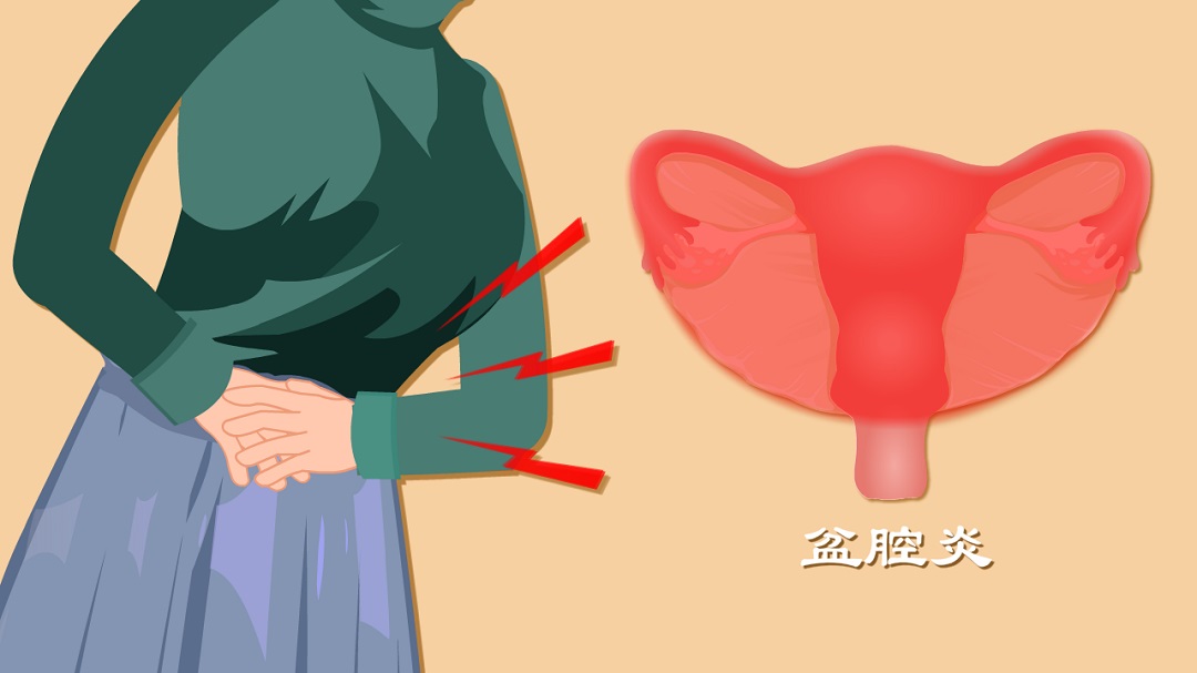 盆腔炎热敷理疗有用吗,盆腔炎热敷就会好很多是盆腔炎吗