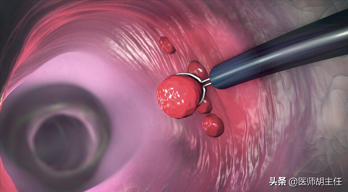 肠道有息肉会出现什么症状,肠道长了息肉有什么症状