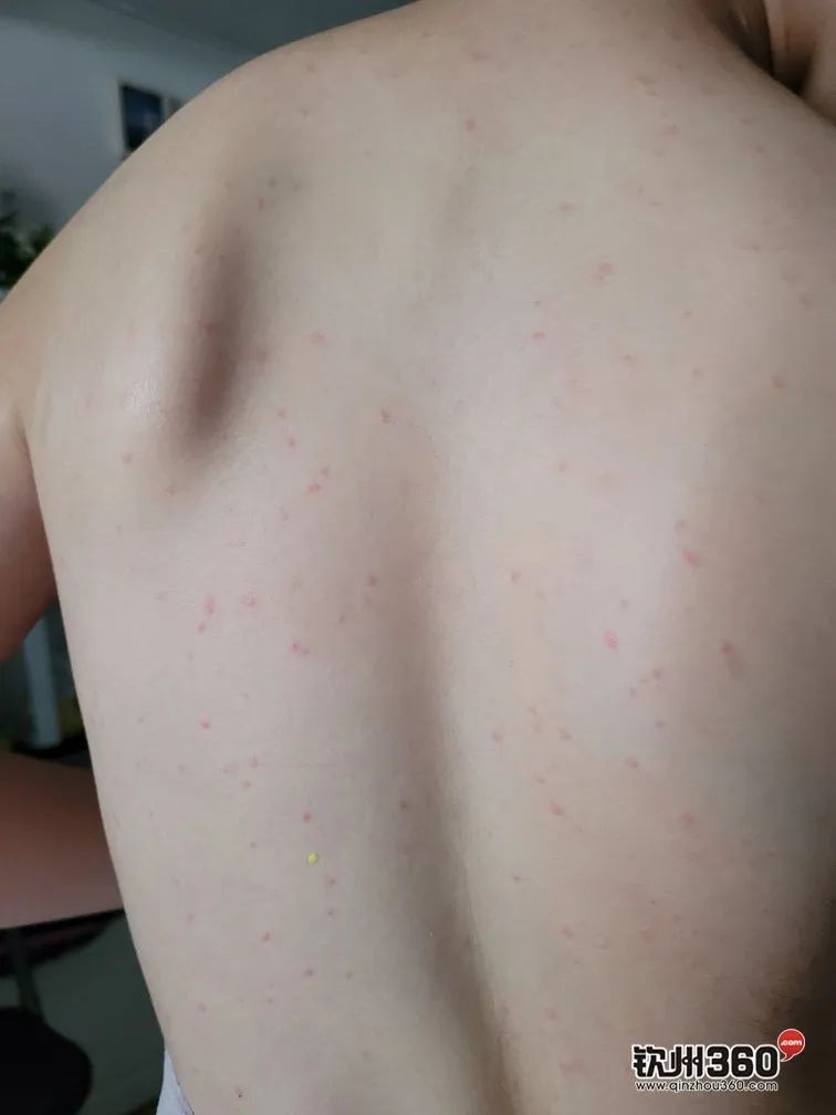 去海边游泳回来全身刺痛,去海边玩后皮肤浮现红点还痒图片