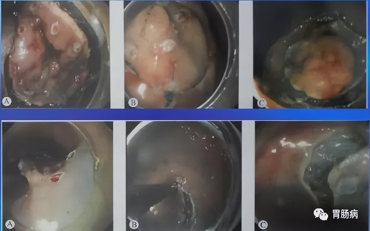 esd内镜下粘膜剥离几天可愈合,内镜下粘膜剥离术属于esd还是emr