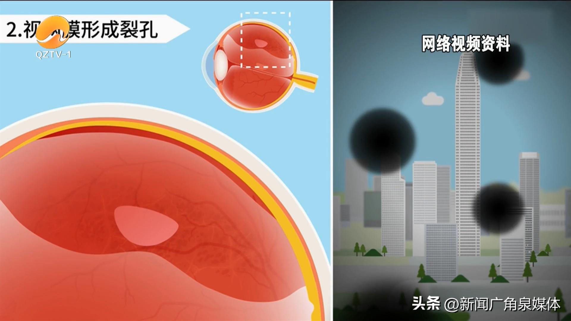 视网膜脱落的飞蚊是什么样,有飞蚊视力模糊怎么办