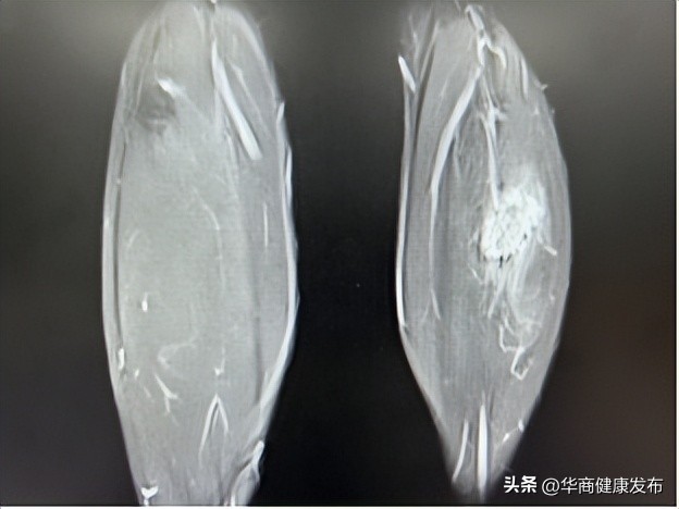 微创腹腔镜是什么,腔镜手术皮下隧道恢复时间