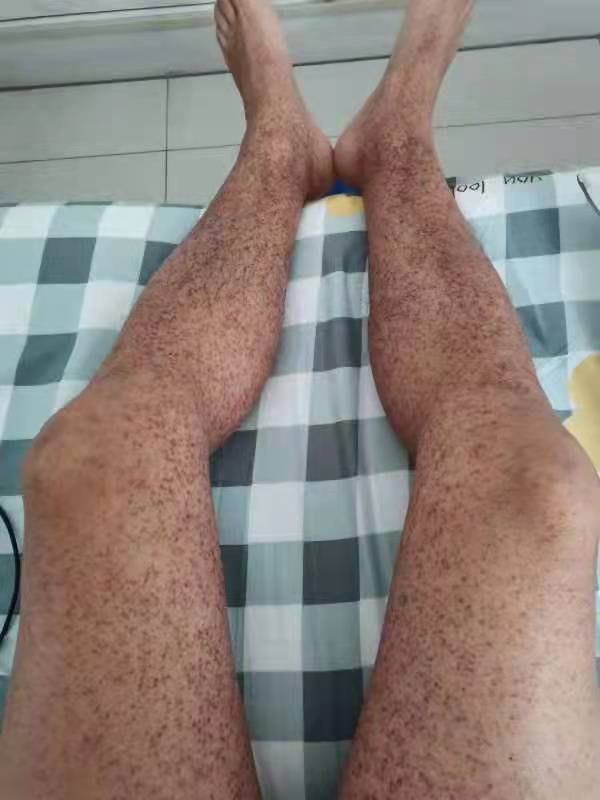 过敏性紫癜喝凉血祛风糖浆有效吗,为什么过敏性紫癜出血时间不延长