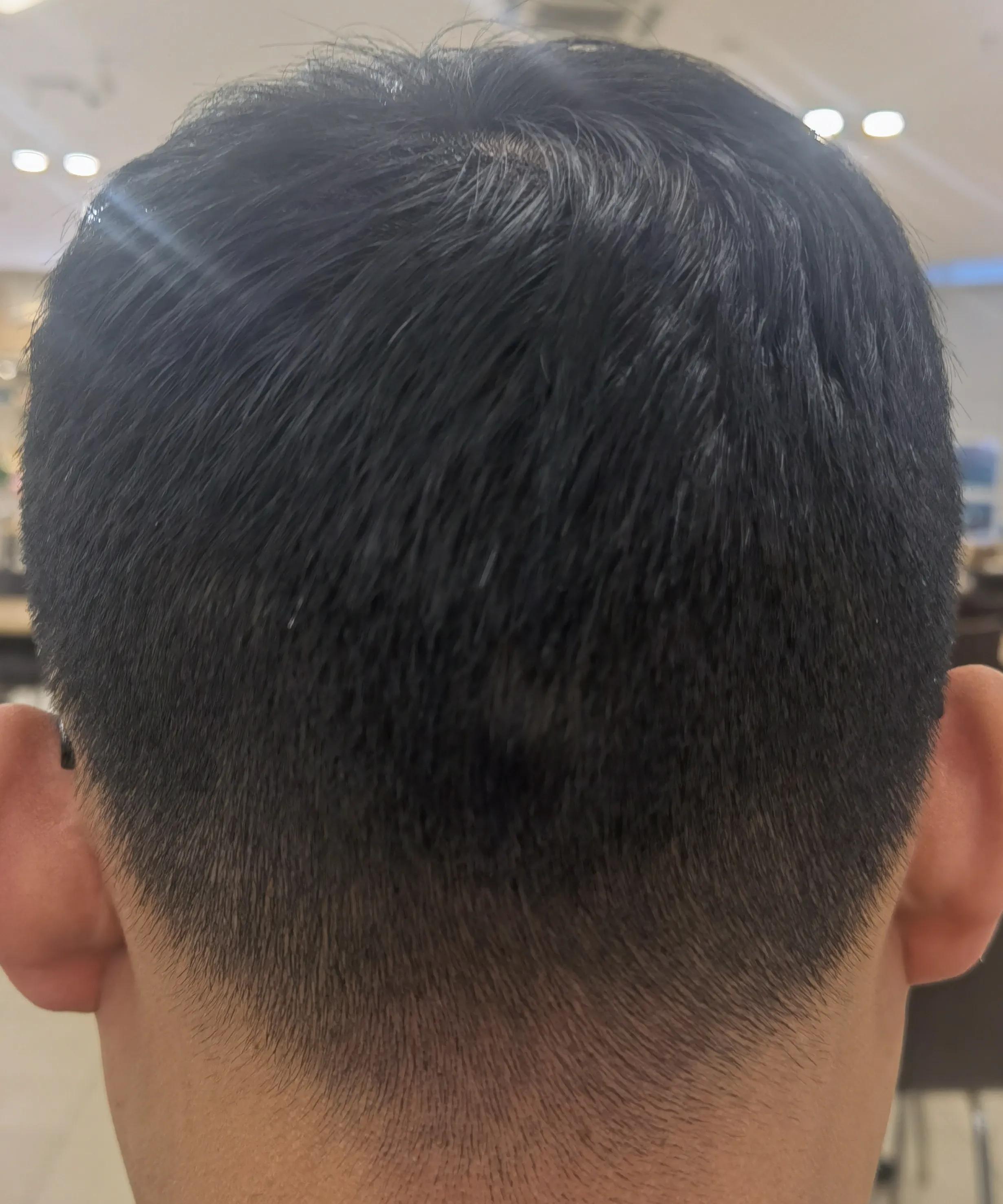 男士植发过来人真实感受,16000字讲述植发真实感受