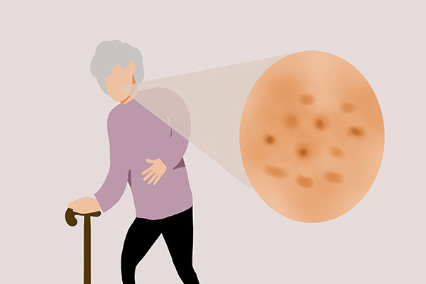 红霉素软膏可以去除老年斑吗,红霉素软膏祛老年斑小妙招