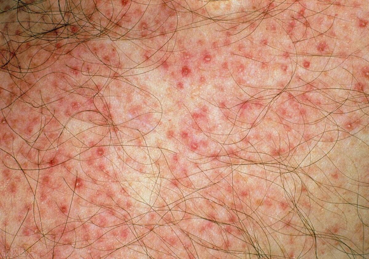 40岁男士脱头发什么原因,男生下部毛囊发痒可以剃掉吗