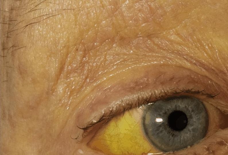 肝衰竭晚期怎么能减轻痛苦,肝衰竭的治疗期间总是低烧