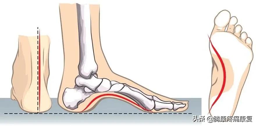 功能性高足弓的练习方式,用什么方法舒缓足弓疼痛