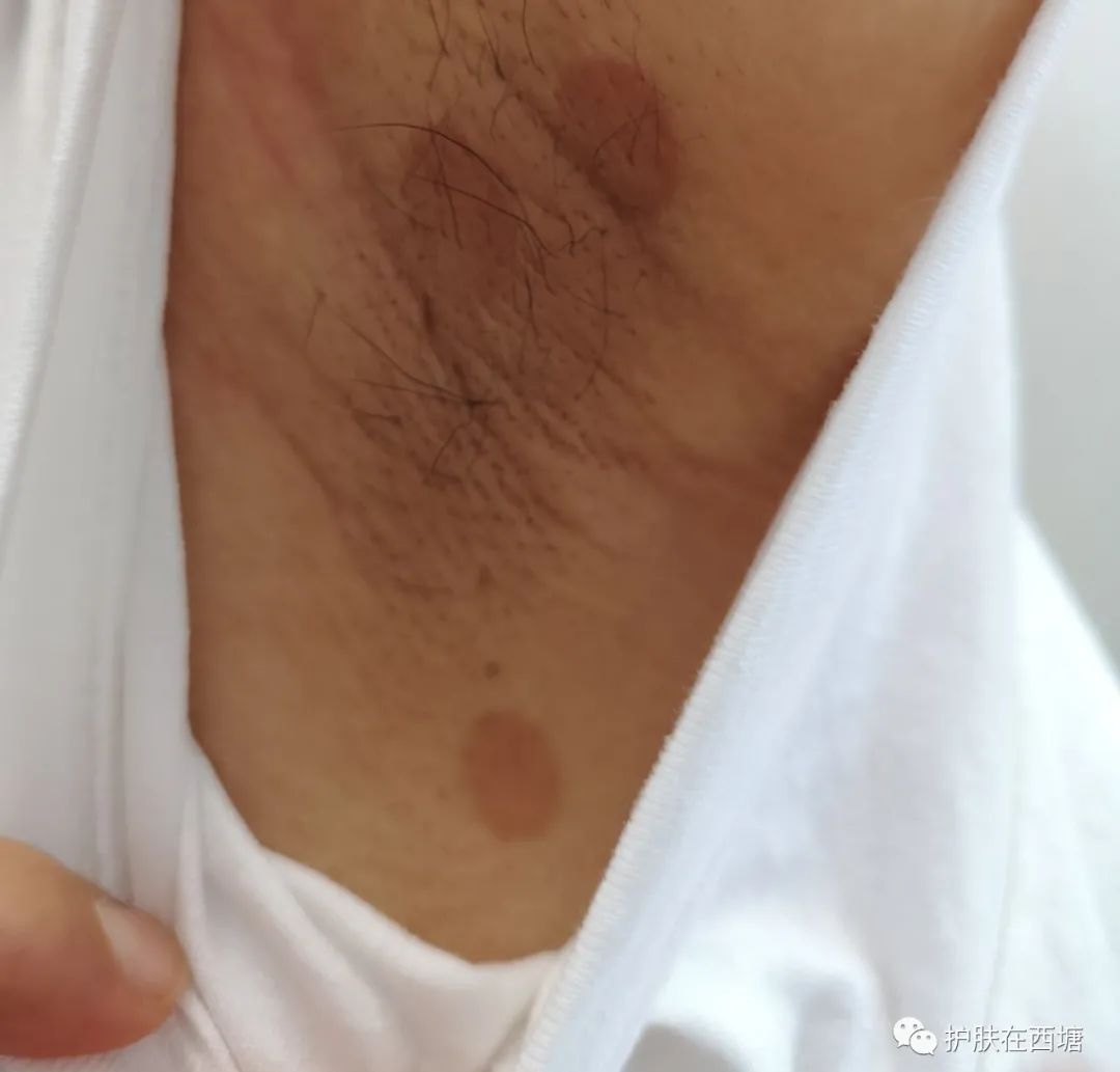 汗斑跟花斑癣,汗斑和花斑糠疹区别