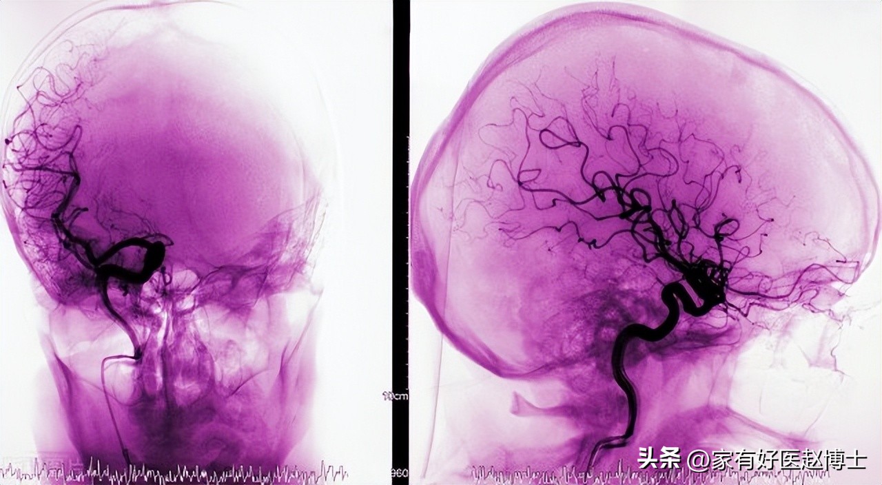 降压药吃了后头晕是什么原因,吃了降压药头有点晕怎么回事