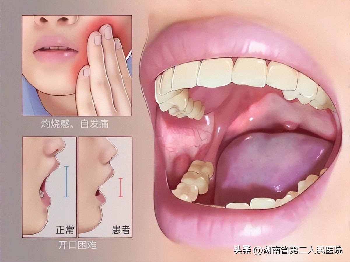 嘴巴越来越张不开什么原因,嘴巴张不开了怎么治好