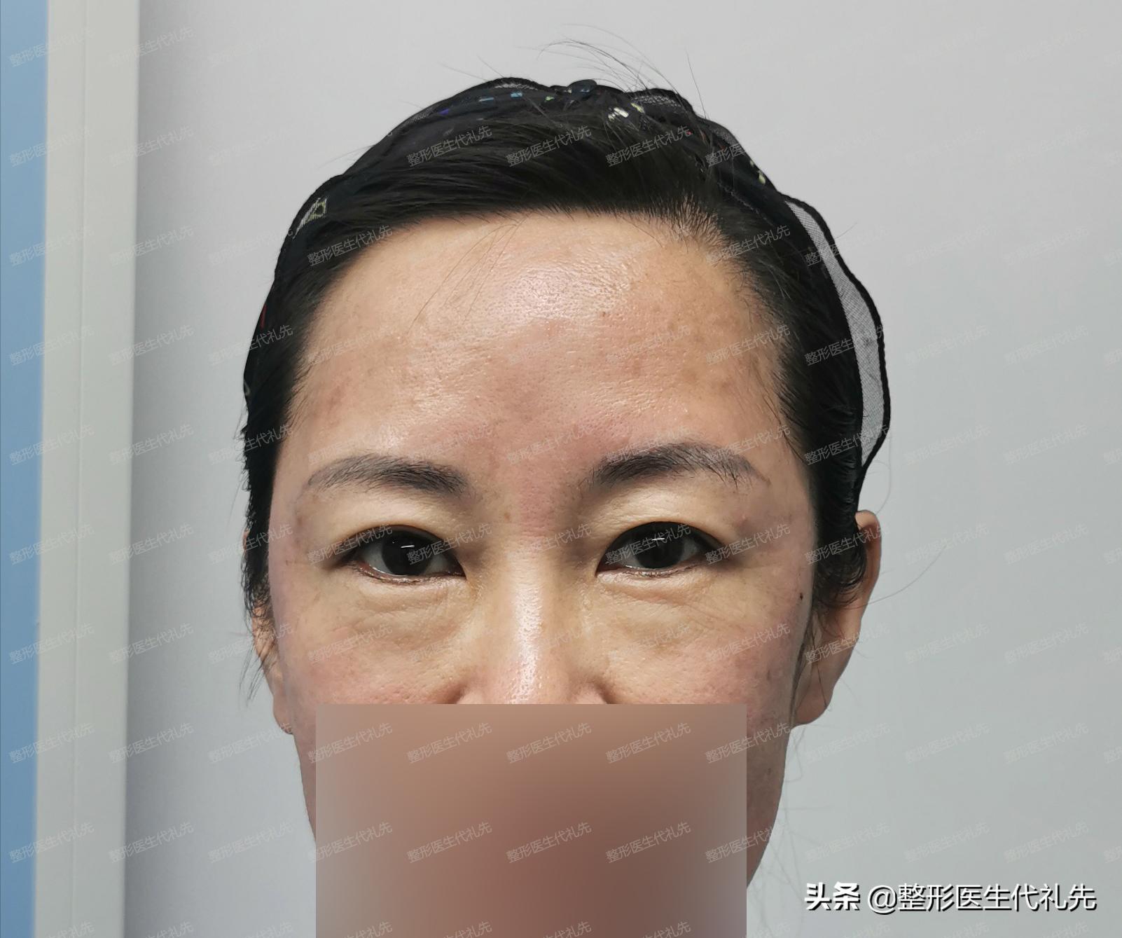 眼袋有皱纹是正常的吗,为什么眼睛下眼袋有点褶皱了