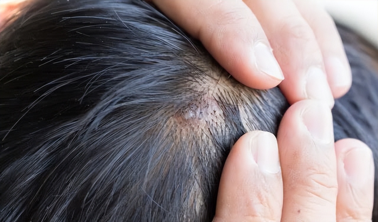 头皮长疙瘩脓包是什么原因,头皮长疙瘩或脓包有哪三种征兆