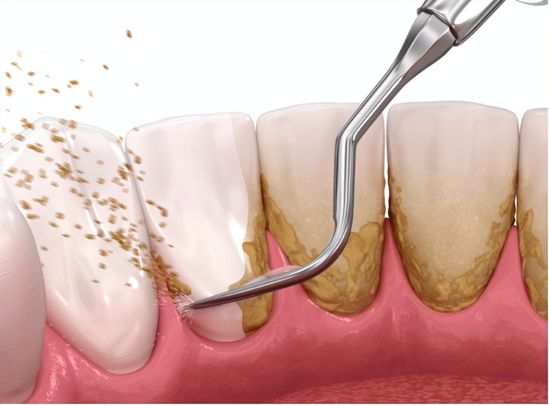 牙龈纤维瘤是肿瘤吗,牙龈纤维瘤会遗传给下一代吗