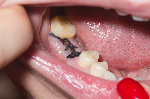 吃包子吃出螺蛳把口腔弄流血了,吃包子吃出三颗假牙