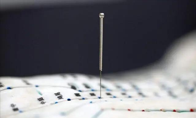 头部脑供血不足穴位,头部穴位针灸的作用