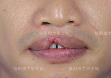唇裂术后显示红唇缺失,唇裂手术后红唇一侧偏厚正常吗