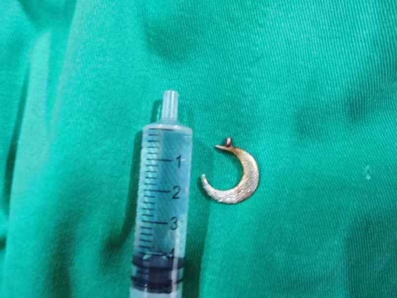 一例无痛小儿食道异物取出术