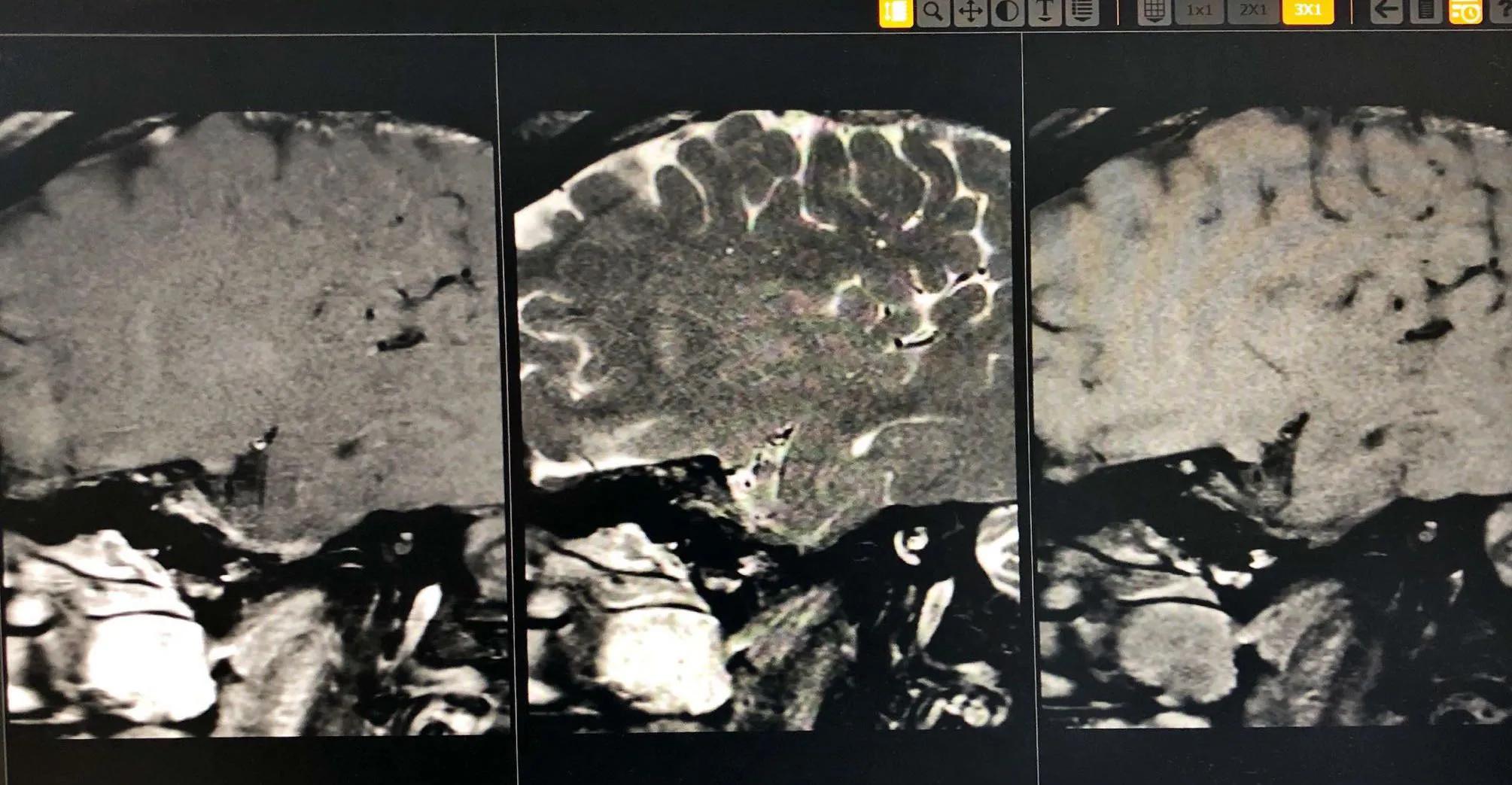 血管健康日为什么定在5月18日,血管的健康日