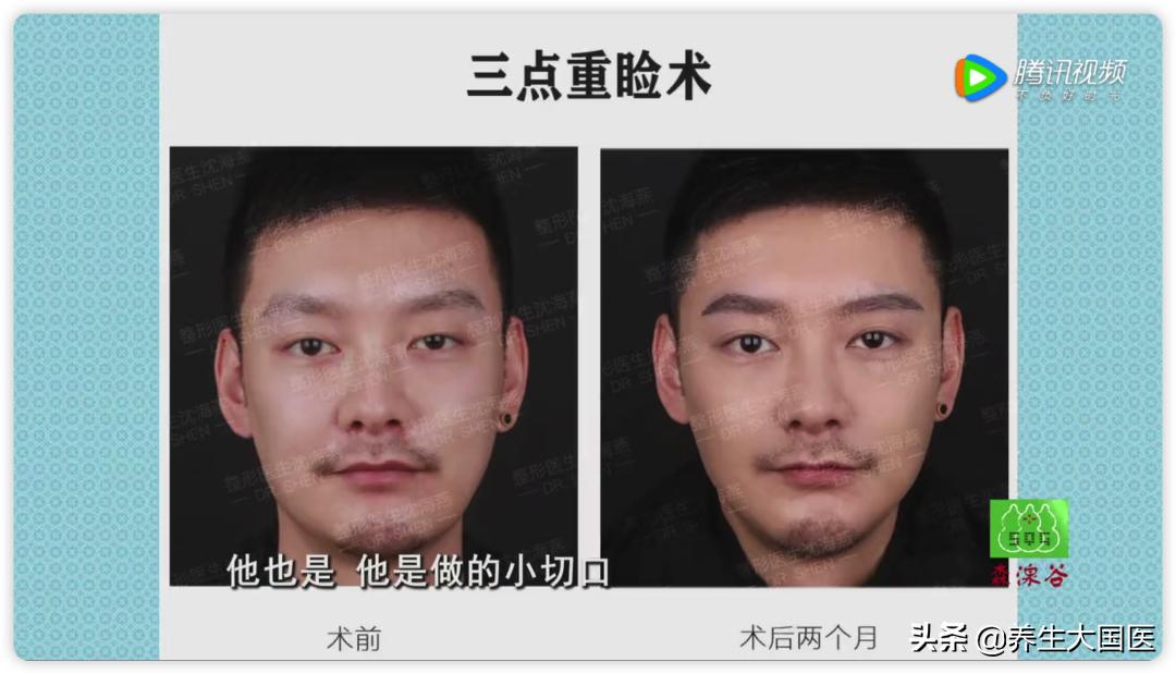 常见的双眼皮手术方法有哪几种啊,如何判断自己适合哪种双眼皮手术