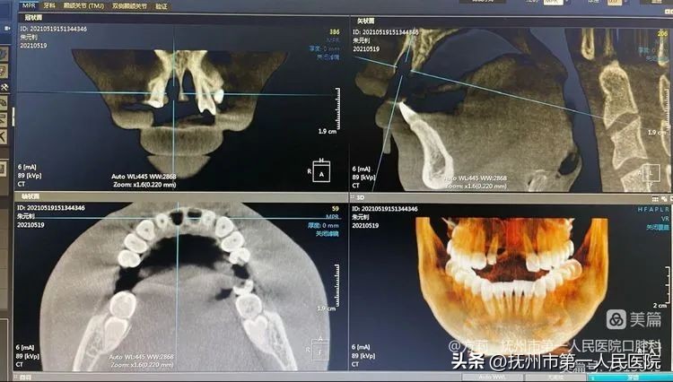 种植牙可修复多种牙齿缺失类型,学科建设口腔科