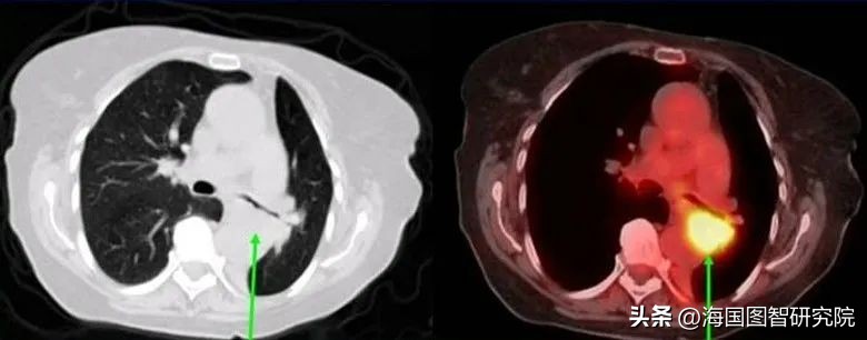 核药能治疗什么,核药能治疗核辐射吗