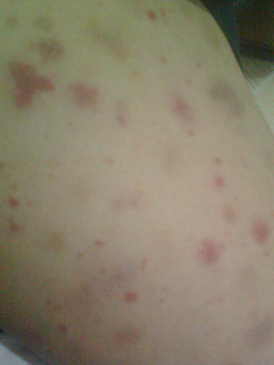 吃了呋喃唑酮片肚子还越拉越厉害,吃多西环素片腹痛还可以继续吃吗