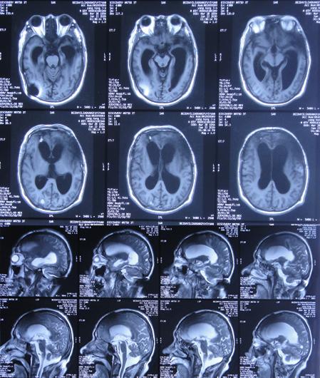 脑外伤后硬膜下积液颅骨修补,颅骨修复手术失败导致脑积水