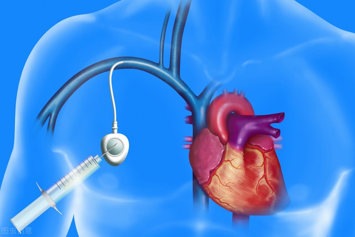 癌症病人输液港是什么,输液港对癌症有什么危害