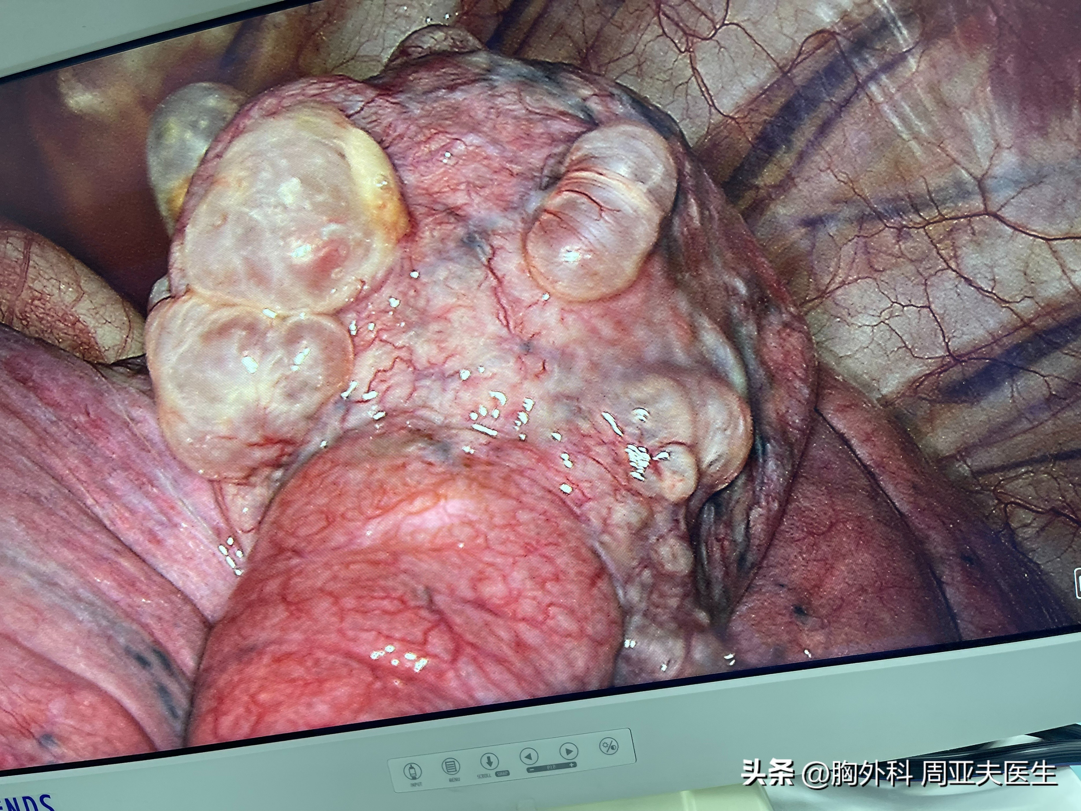 关于气胸的讨论,关于气胸