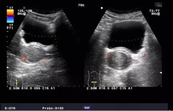 子宫脱垂一般妇检能不能看到,妇科子宫脱垂健康科普知识