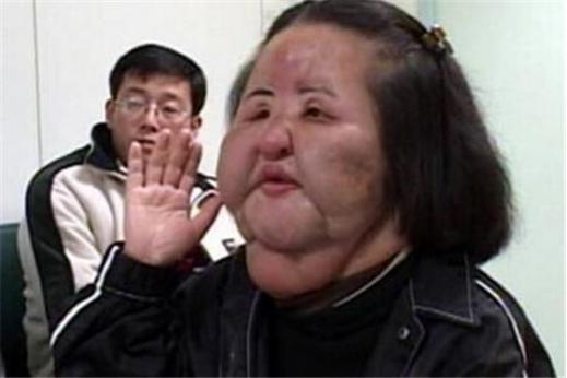 韩国“电风扇大妈”：为变美整容，给自己注射大豆油，用石蜡填充