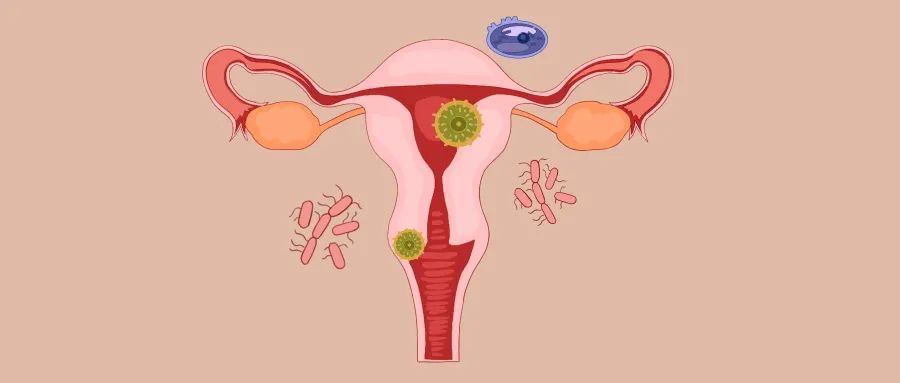 女人下面瘙痒难耐，还有臭味，这是怎么回事？