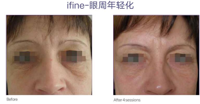 美迪迈相控微针是什么,美迪迈相控微针多久能化妆