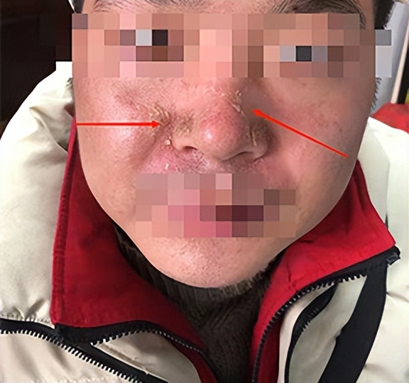 脸部红肿淌黄水是什么症状,脸上流黄水反复发作