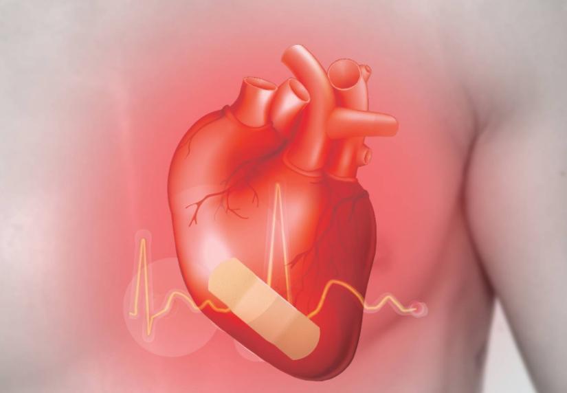 心肌缺血应该吃什么药效果好,心肌缺血吃什么药效果更好