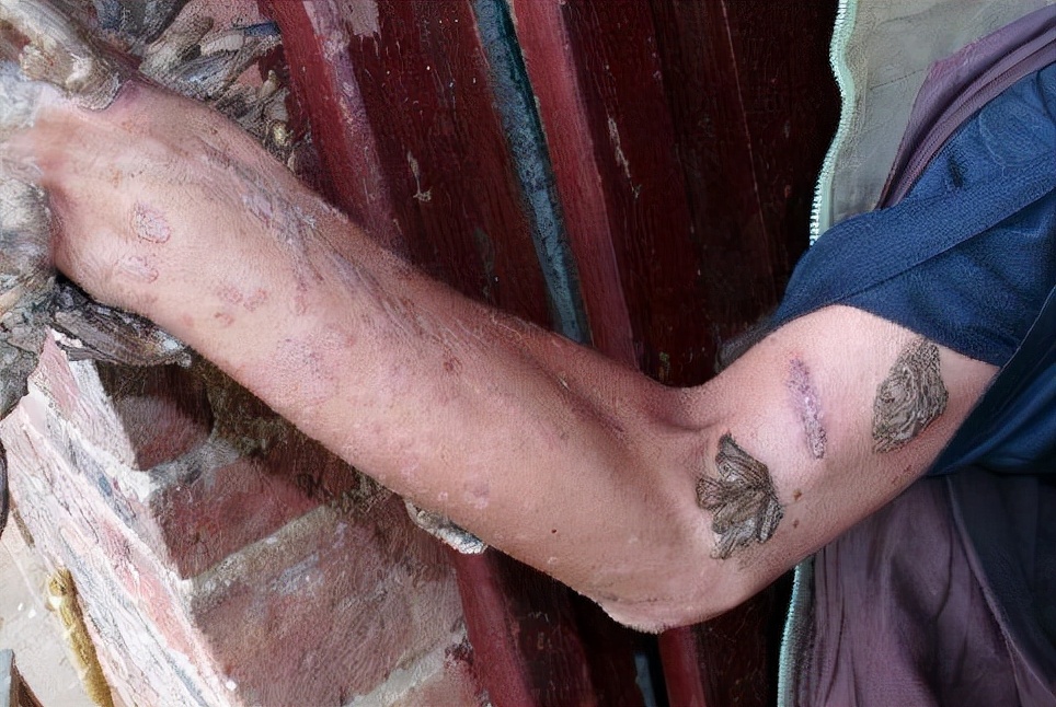 男子手长满树疙瘩是什么病,男子手长满树疙瘩手术了吗