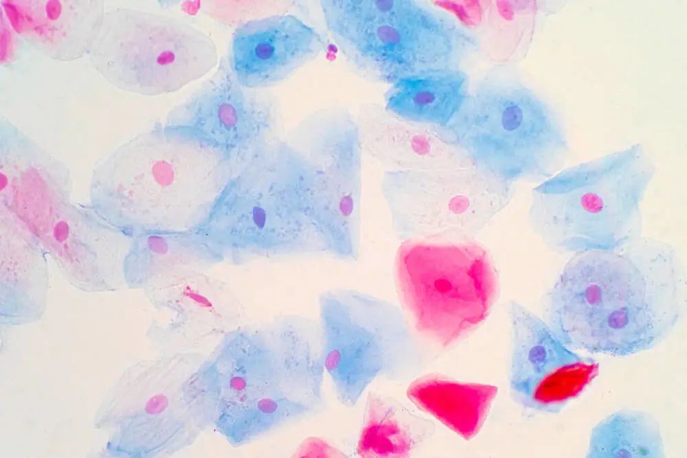 宫颈癌怎么筛查最让人放心？检测报告怎么看？